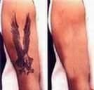 tatuajelor scoaterea tatuajelor este proces serios care trebui aplicat grija. tatuajele sunt facute ๋�ADMIN๋�