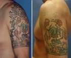 tatuajelor ajutorul laserului laserele medicale folosesc fascicul intens lumina pentru inlatura ๋�ADMIN๋�